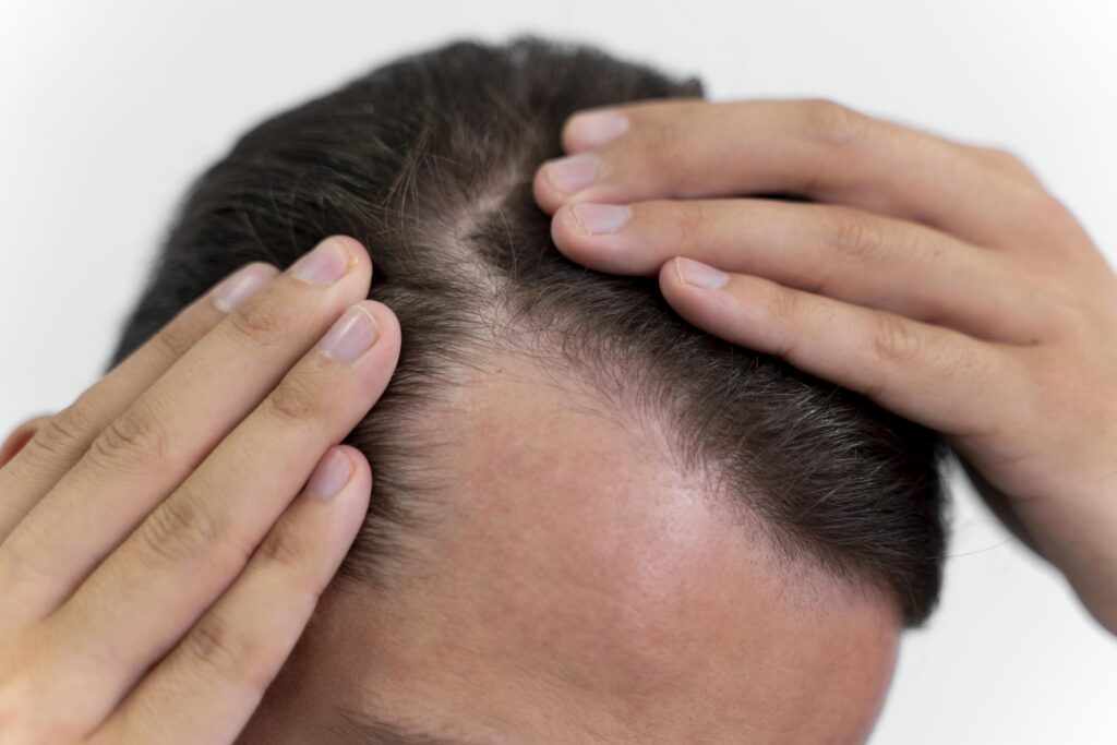 How To Stop Hair Loss and Regrow Hair Naturally