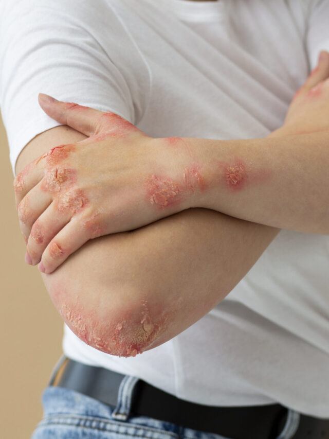 What is Psoriasis