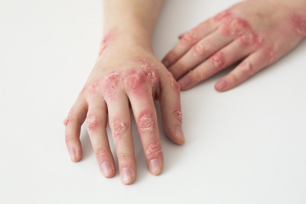 Psoriasis Pictures