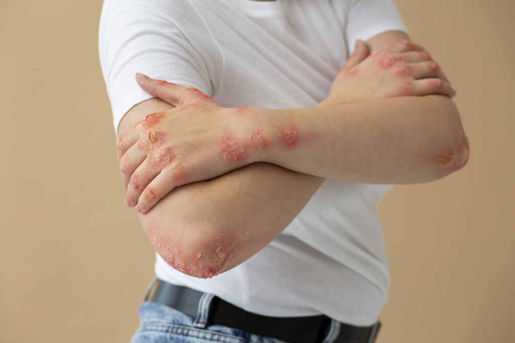 What is Psoriasis