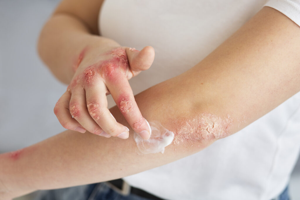 Psoriasis Treatment