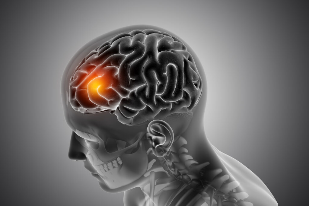 Brain Tumor Symptoms