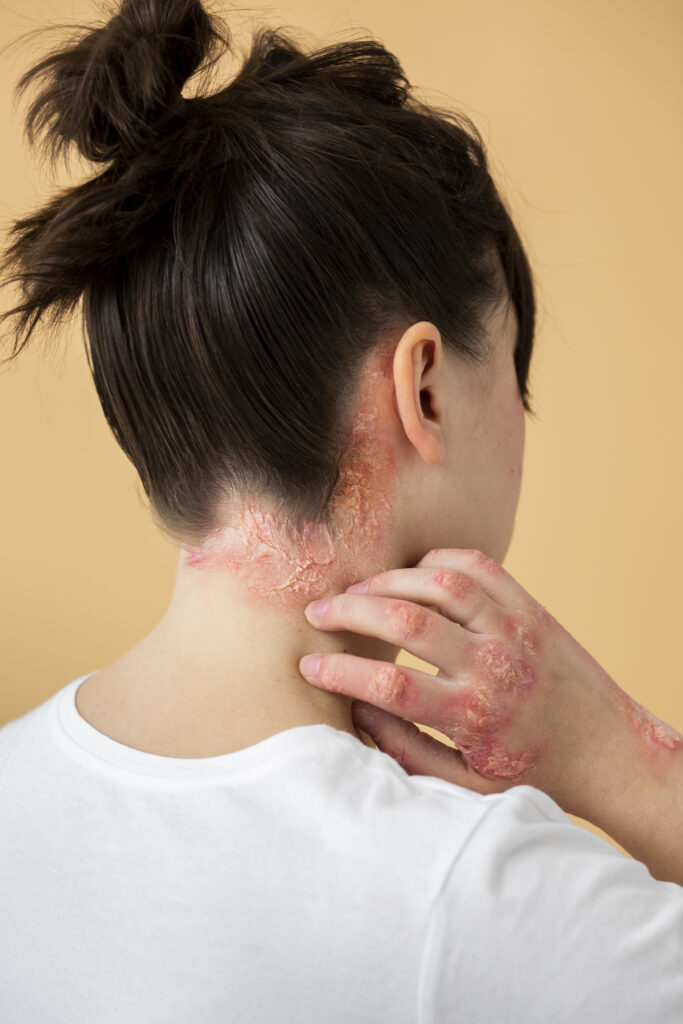 Psoriasis Symptoms